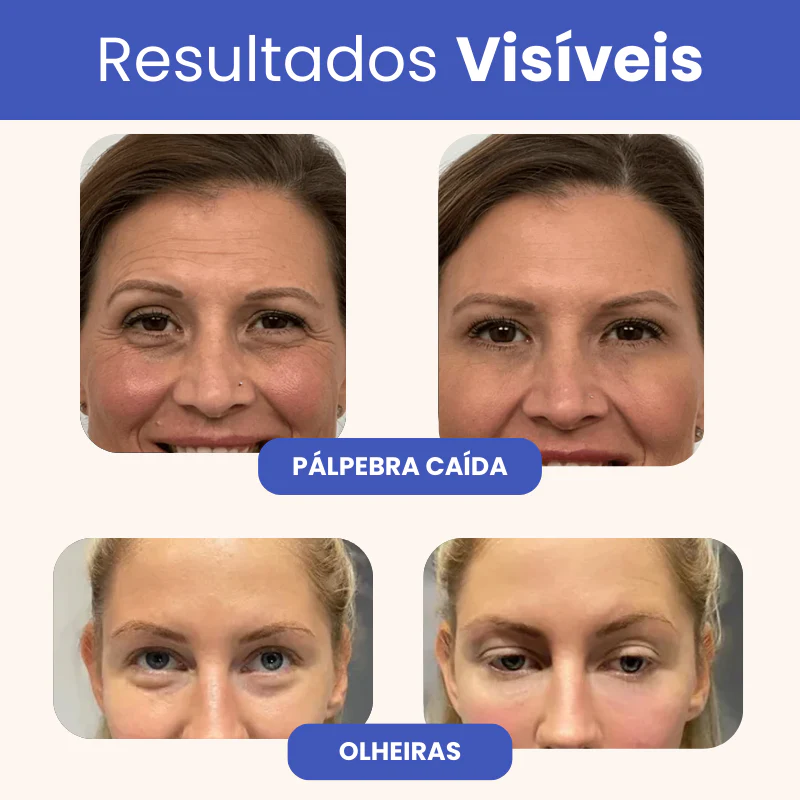 Eleva 10 em 1 - Pálpebra, Bolsas e Rugas - Image 4